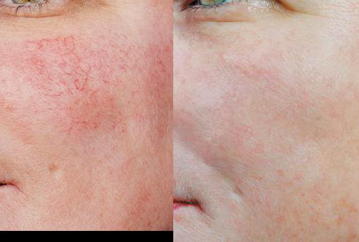 Laugmentation de la pigmentation de la personne