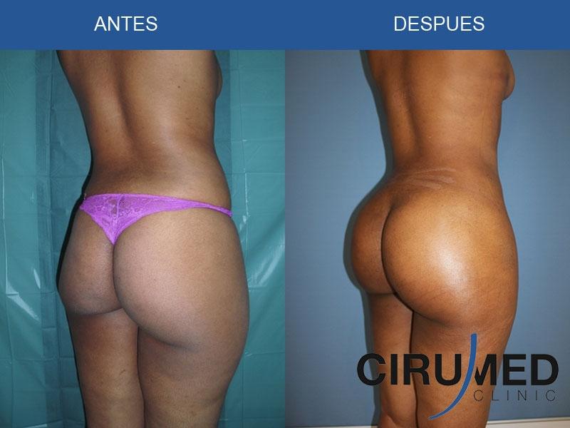 Brazilian Butt Job 82