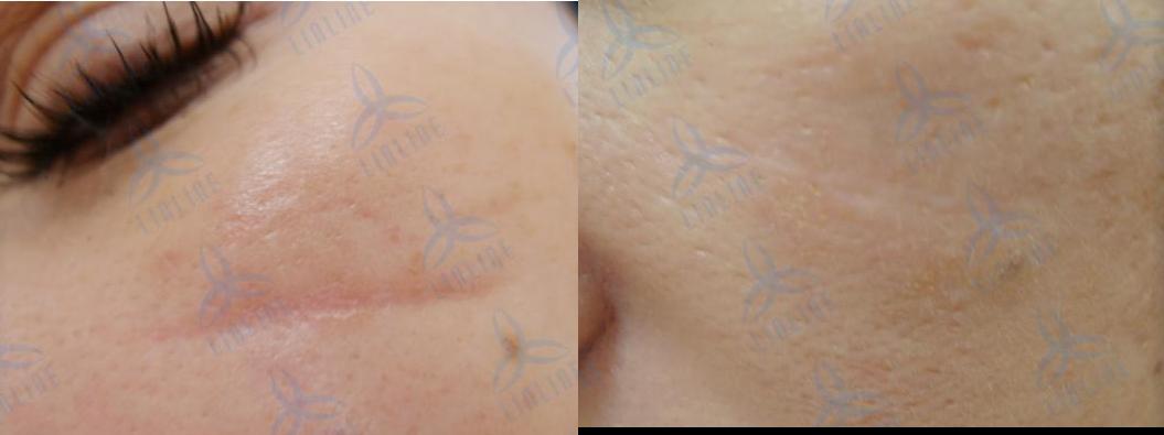 Le vinaigre de pomme du psoriasis de la tête les rappels