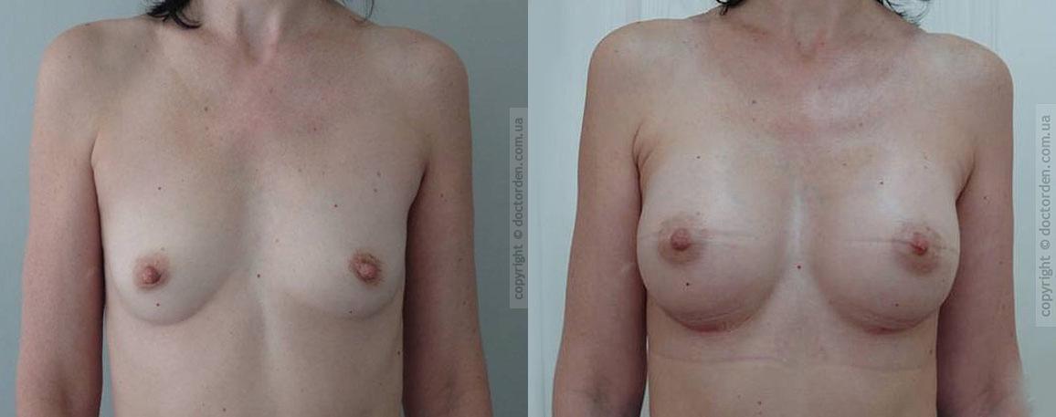 Lécho les signes de la thrombose