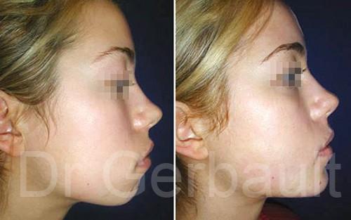 age anti medecin 92 du esthétique Chirurgie Génioplastie   France menton
