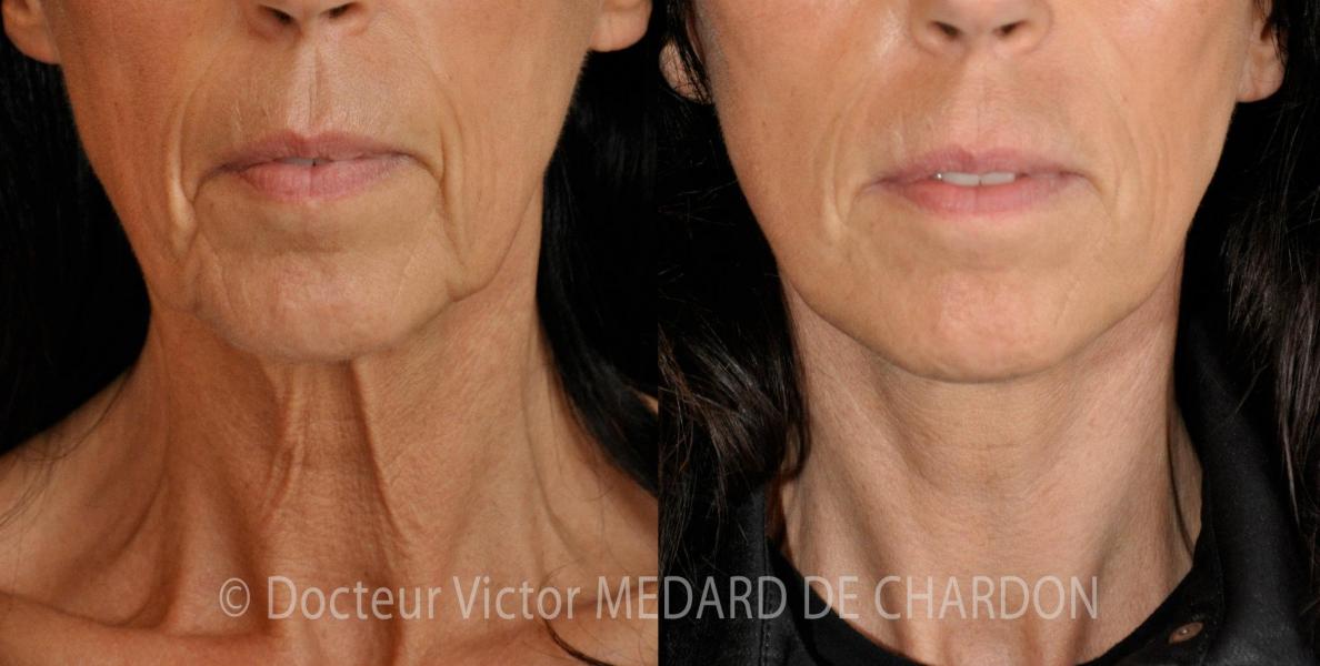 mesotherapie tarif