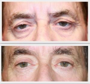 Blépharoplastie dr hayot