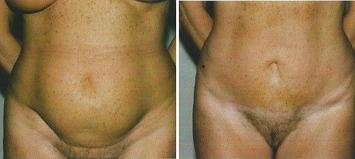 abdominoplastia2