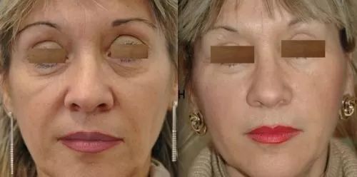 Lifting Medio Facial