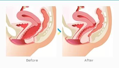 vaginoplastie5