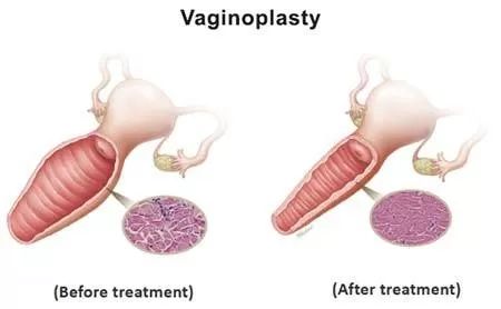 vaginoplastie3