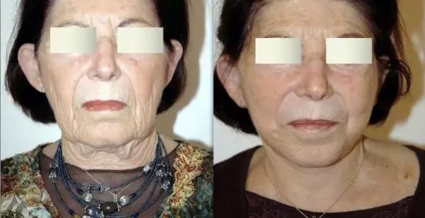 09 Résultat lifting cervico facial