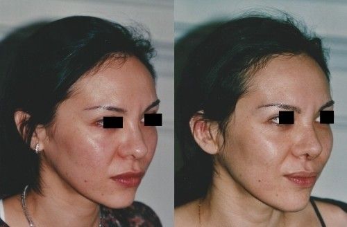 Rhinoplastie Asiatique 4