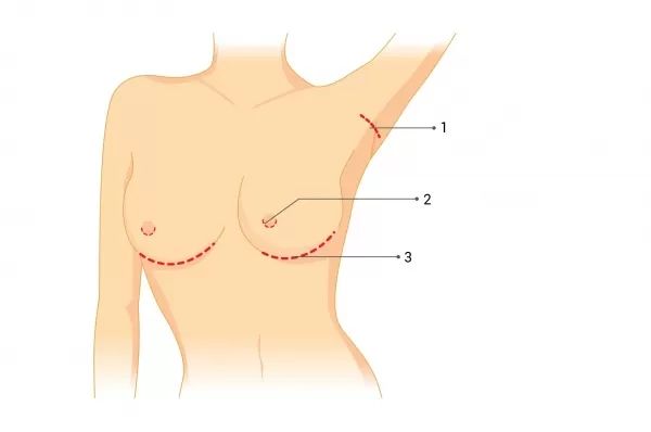operacni pristupy augmentace prsou