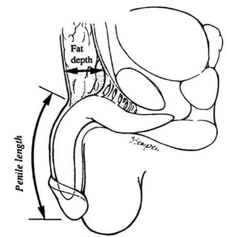 Article pénoplastie 5