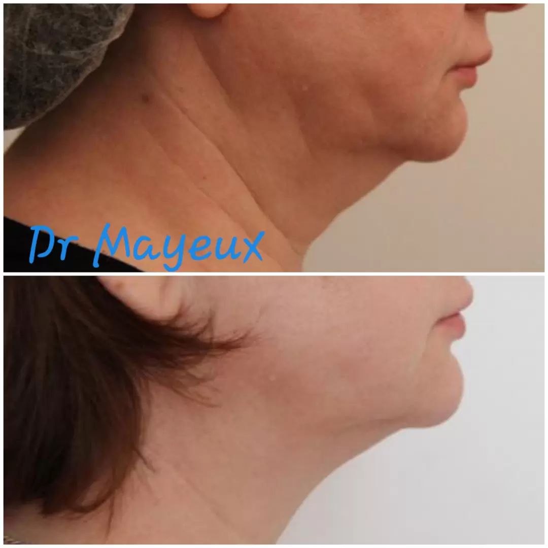 cryolipolyse Double menton profil