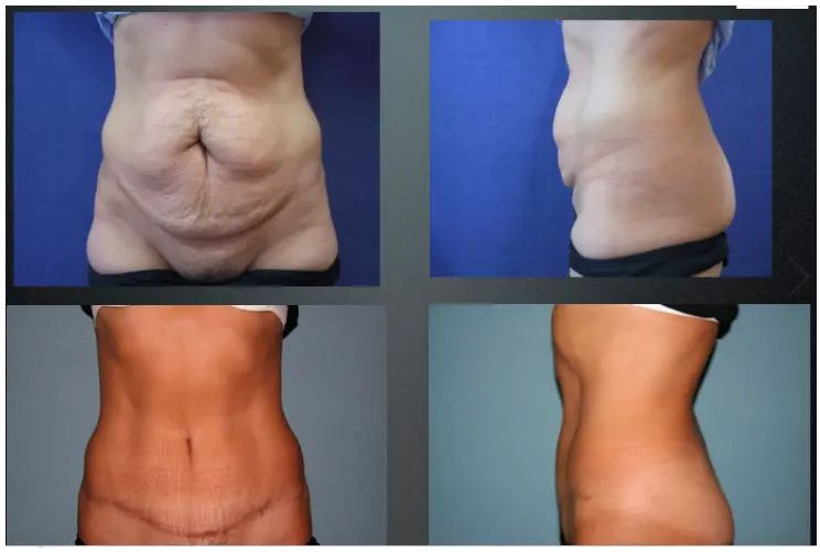 résultat-abdominoplastie