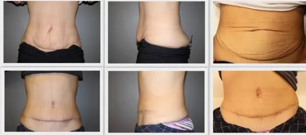 abdominoplastie