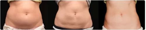 coolsculpting1