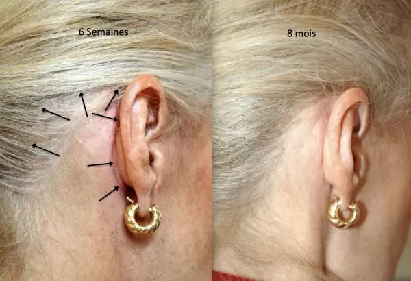 16 Cicatrices Lifting cervico facial arrière 