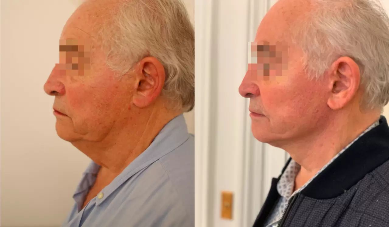 photo facelift resultat