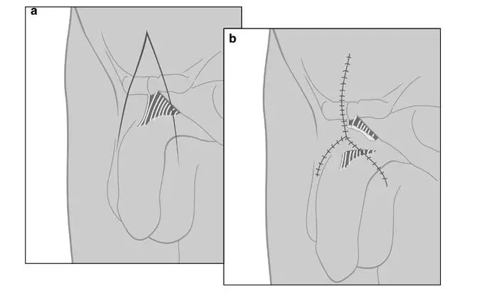 Article pénoplastie 6