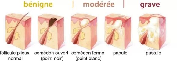 stades acné laser