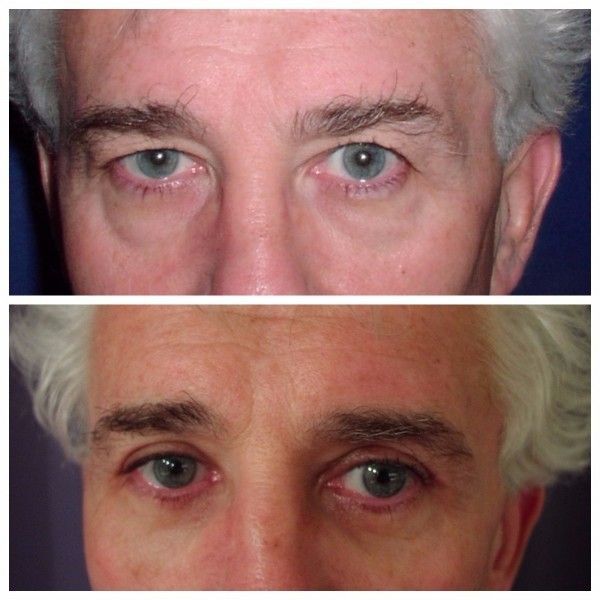 blefaroplastika