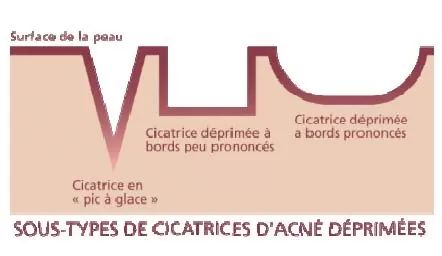 cicatrices1