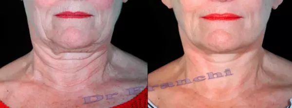 lifting visage, photo avant et après