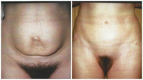 abdominoplastia