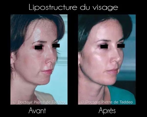 photo avant et apres lifting visage