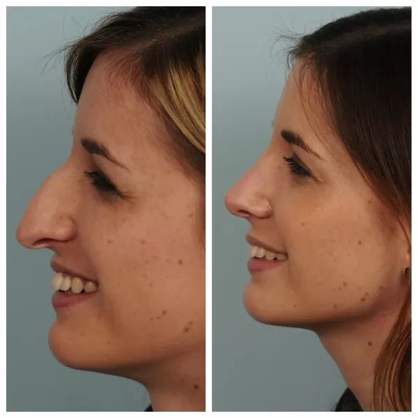 Rhinoplastie5