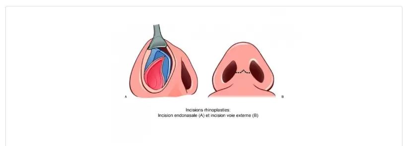 Incision endo-nasale et incision voie externe en rhinoplastie